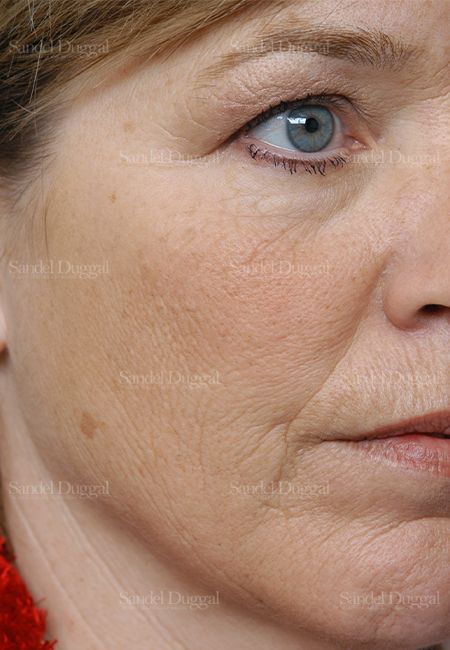Laser Skin Resurfacing before, case 2981