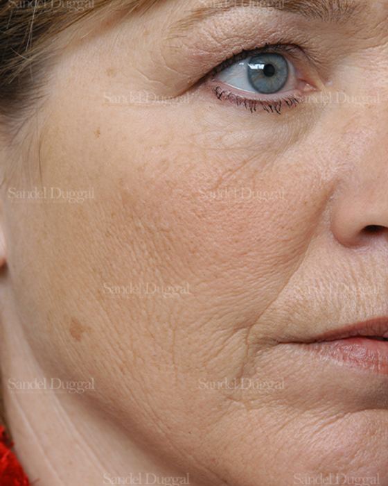 Laser Skin Resurfacing before, case 2981