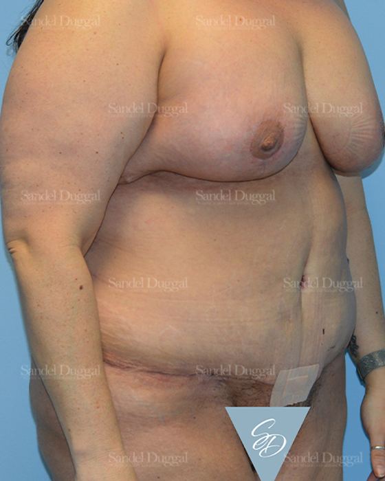 Tummy Tuck after, case 1547