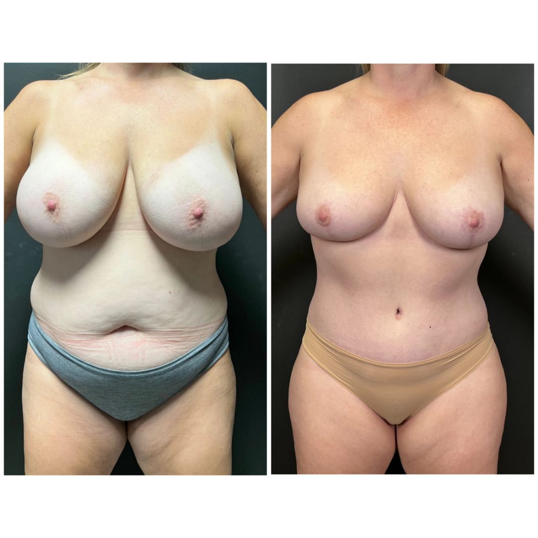 Mommy Makeover before and after, case mommy-makeover-04