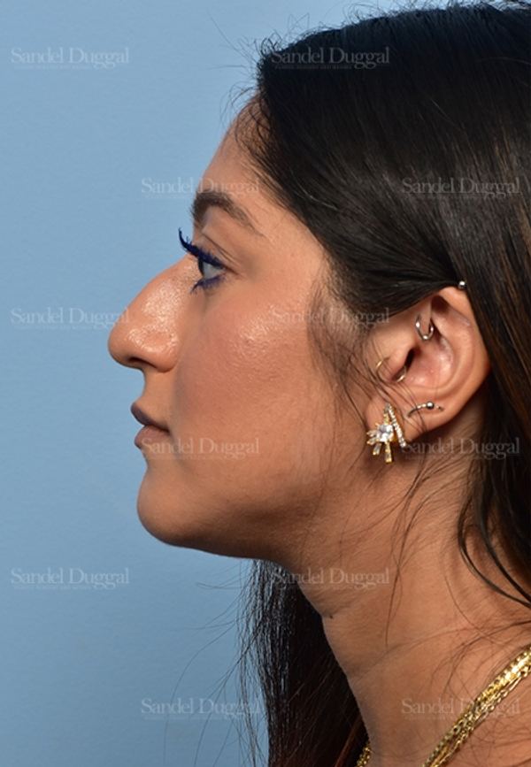 Non-Surgical Rhinoplasty before, case 5372