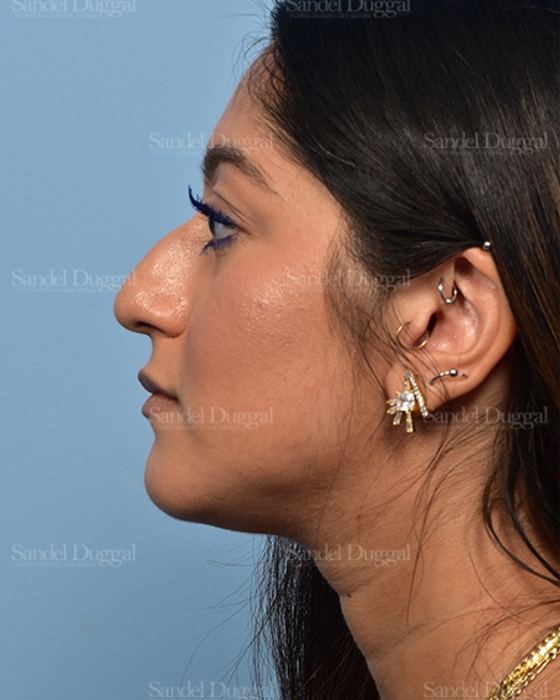 Non-Surgical Rhinoplasty before, case 5372