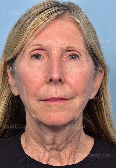 Facelift before, case 5735