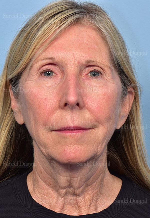 Facelift before, case 5735