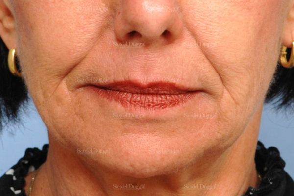 Botox & Fillers before, case 2588