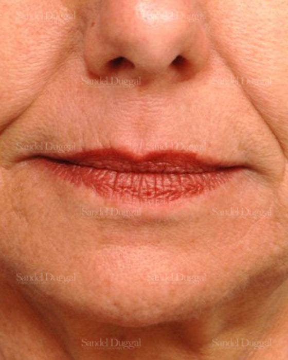Botox & Fillers before, case 2588