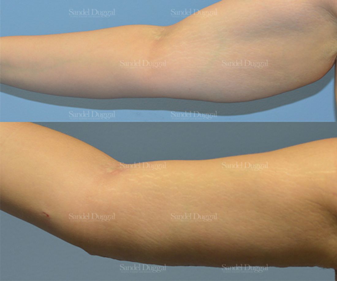 Brachioplasty before and after, case 2129