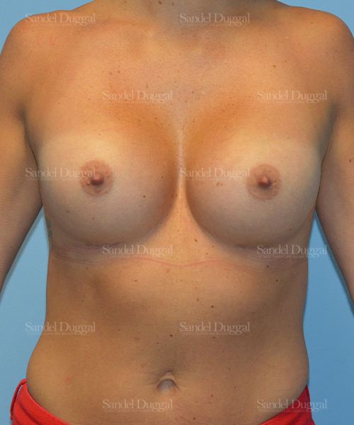 Breast Augmentation after, case 3171