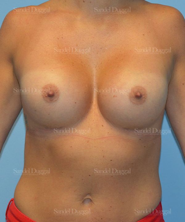 Breast Augmentation after, case 3171