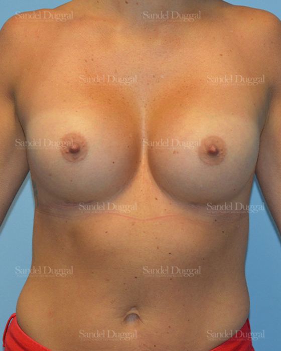 Breast Augmentation after, case 3171