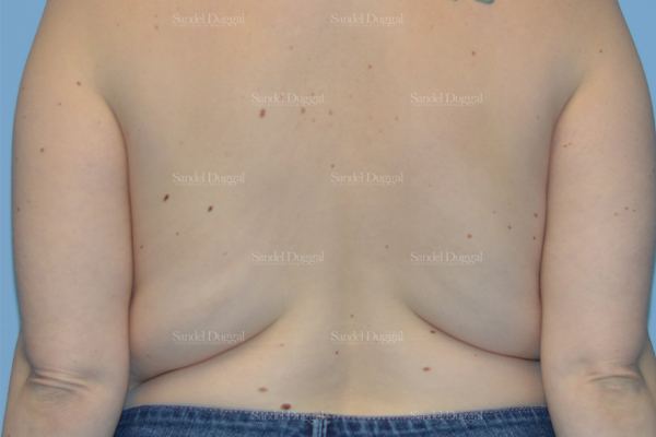 Liposuction — Bra Roll before, case 2495