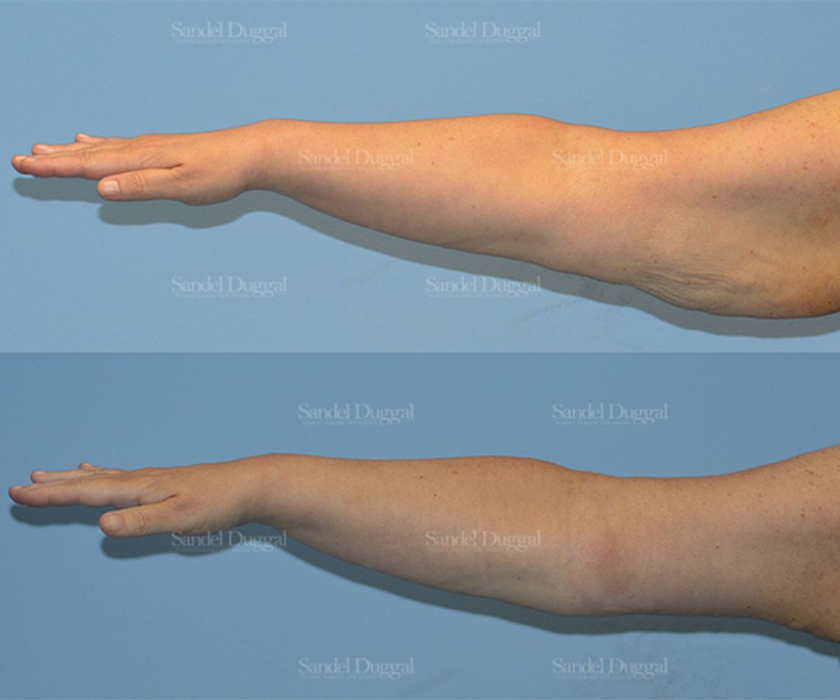 Brachioplasty before and after, case 2108