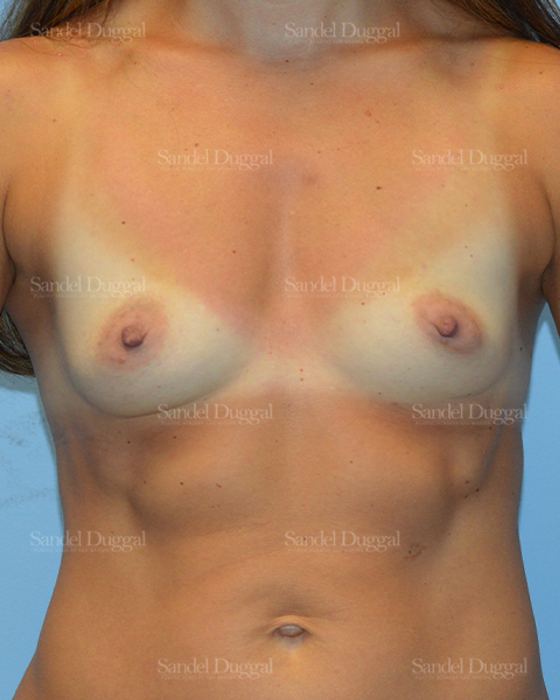 Breast Augmentation before, case 3157