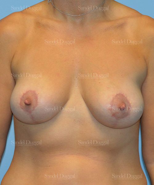 Breast Lift after, case 3329