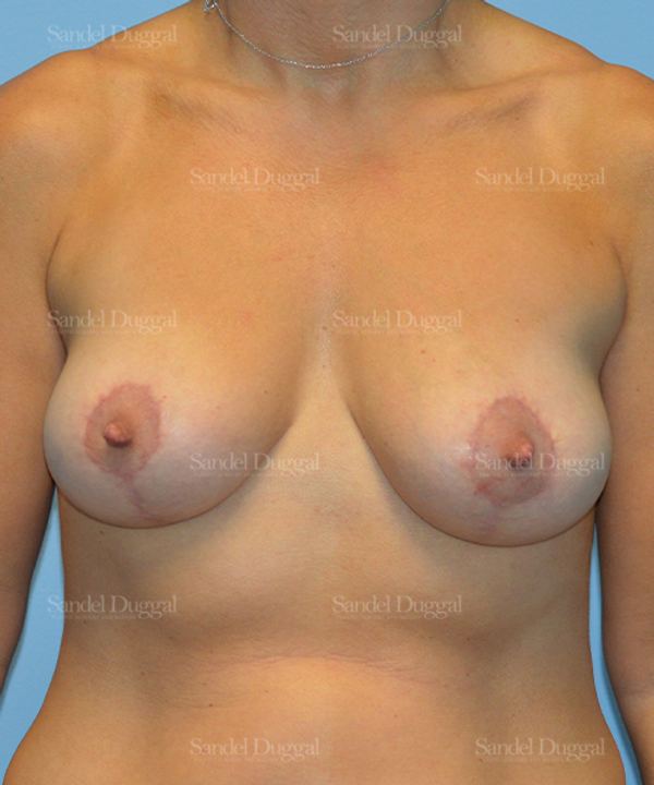Breast Lift after, case 3329