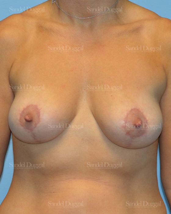 Breast Lift after, case 3329