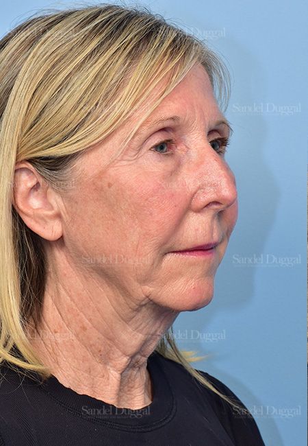 Facelift before, case 5735
