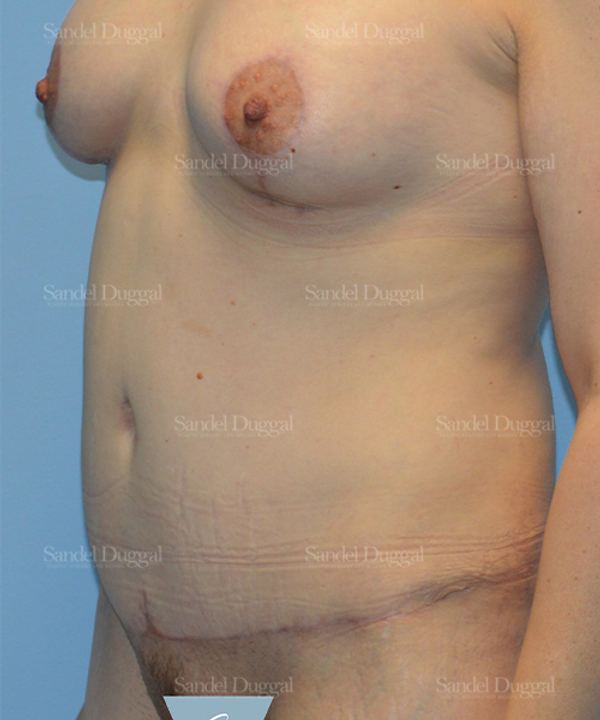 Tummy Tuck after, case 1615