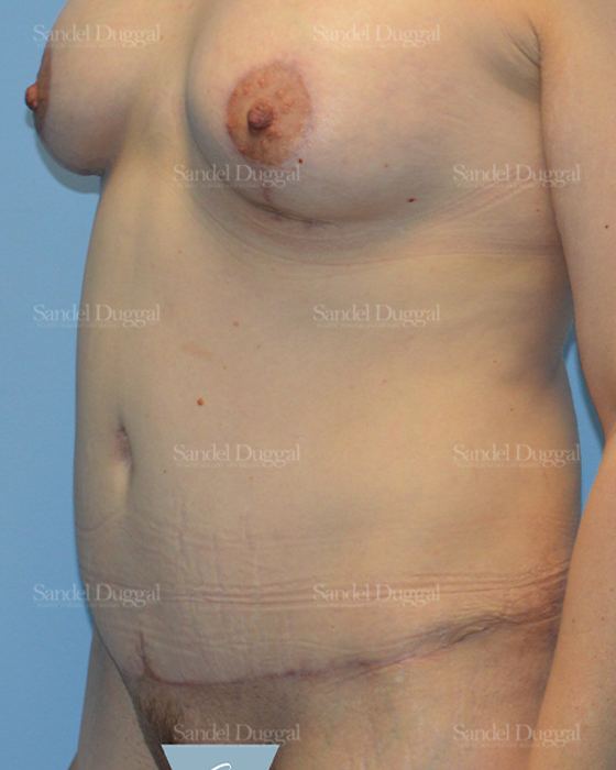 Tummy Tuck after, case 1615