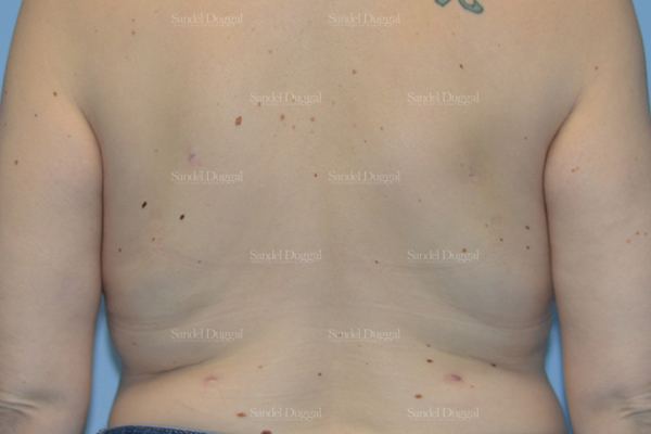 Liposuction — Bra Roll after, case 2495