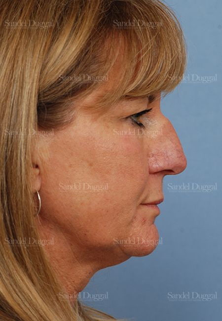 Rhinoplasty before, case 2918