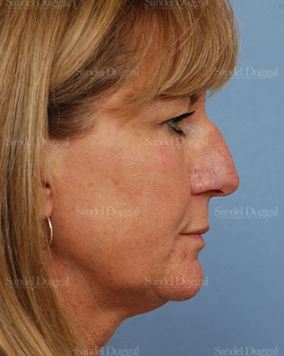 Rhinoplasty before, case 2918