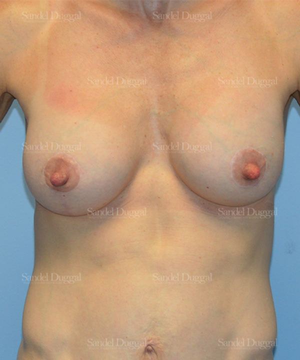 Breast Augmentation with Lift after, case 3400
