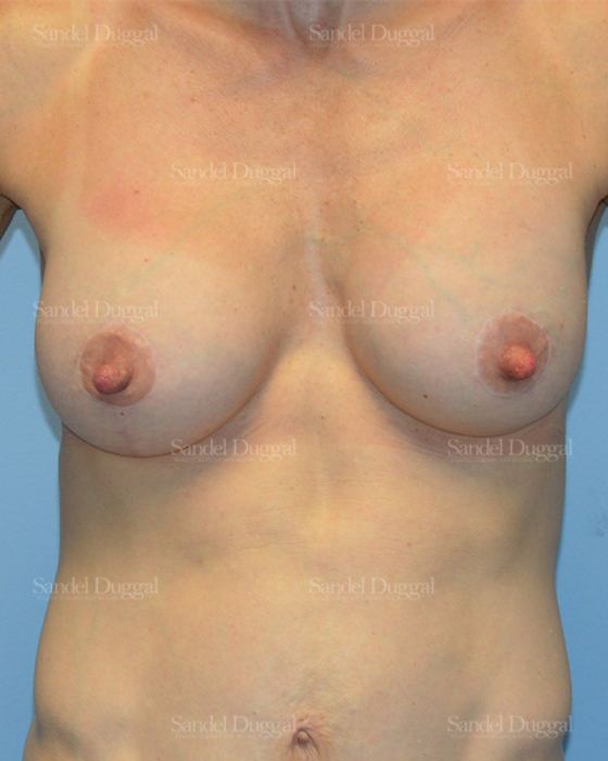 Breast Augmentation with Lift after, case 3400
