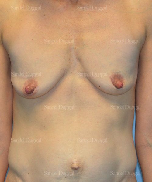 Breast Augmentation with Lift before, case 3400