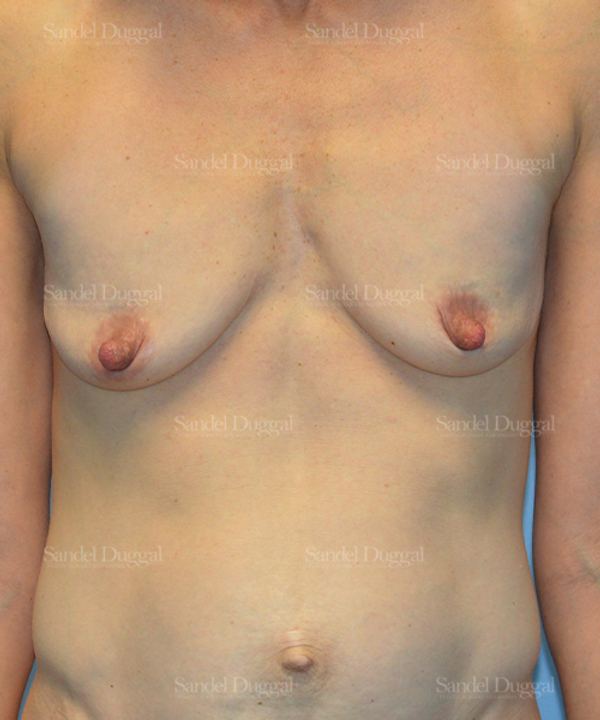 Breast Augmentation with Lift before, case 3400