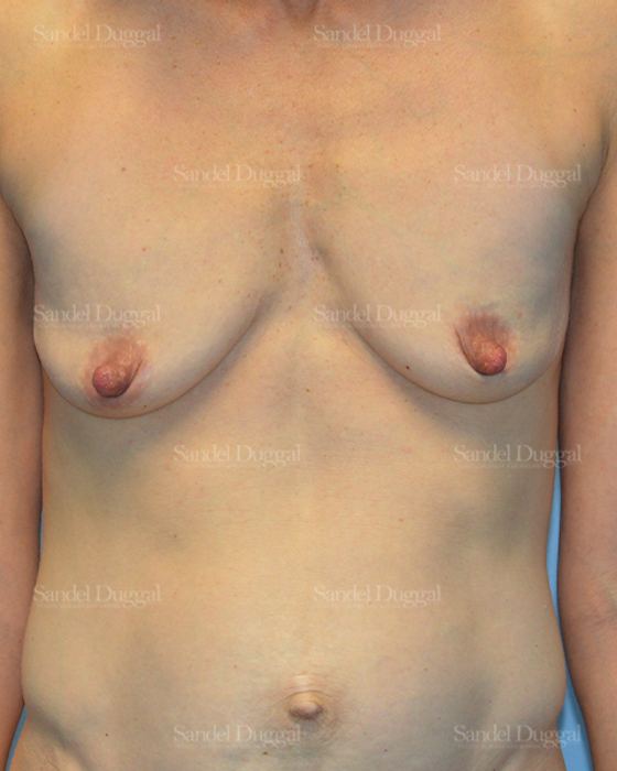 Breast Augmentation with Lift before, case 3400