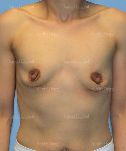 Breast Augmentation before, case 3255