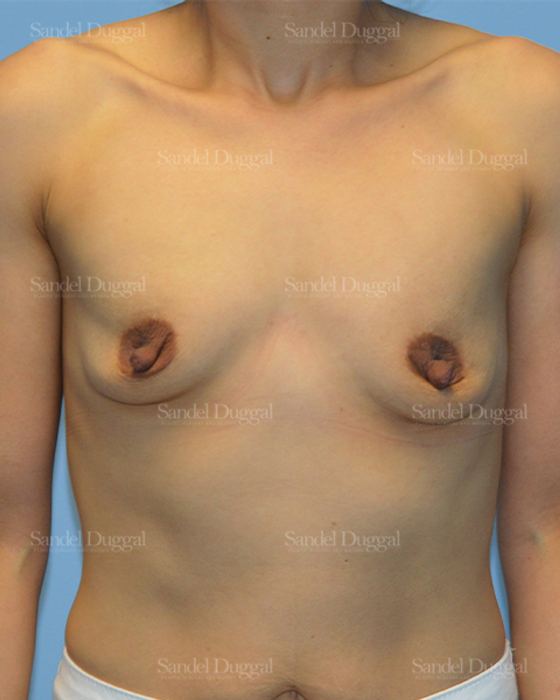 Breast Augmentation before, case 3255