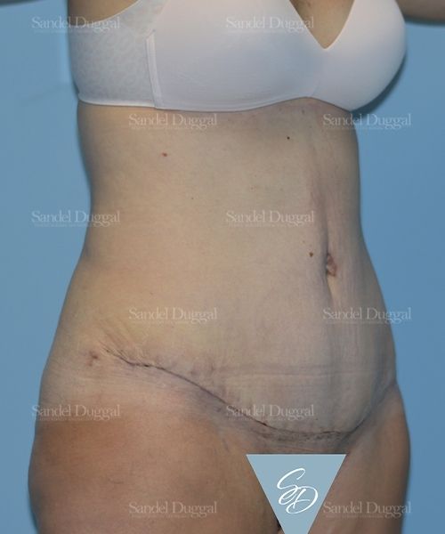 Tummy Tuck after, case 1722