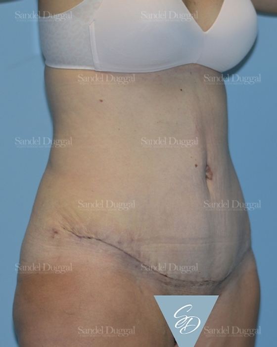 Tummy Tuck after, case 1722