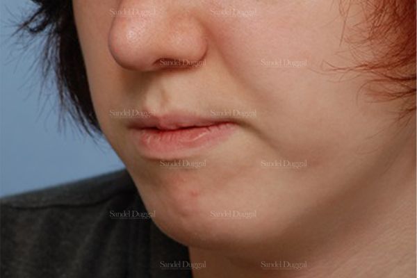 Chin Augmentation after, case 1469