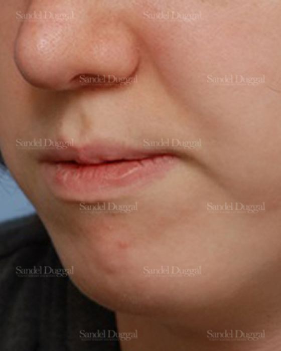 Chin Augmentation after, case 1469