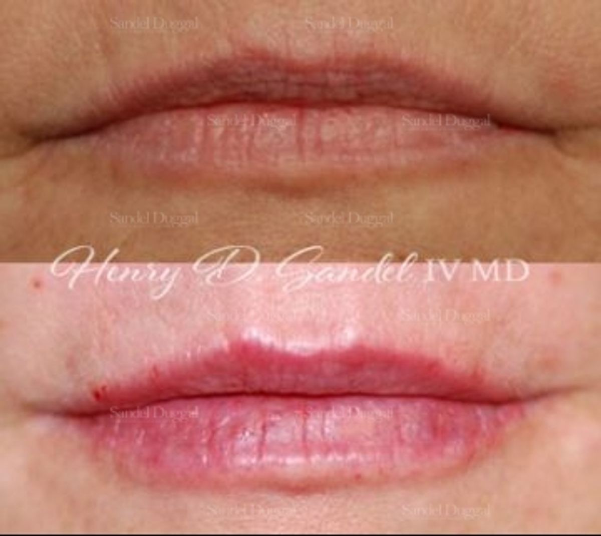 Lip Augmentation / Lip Lift before and after, case 4403