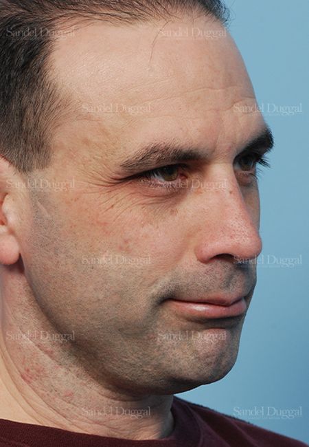 Rhinoplasty after, case 2909