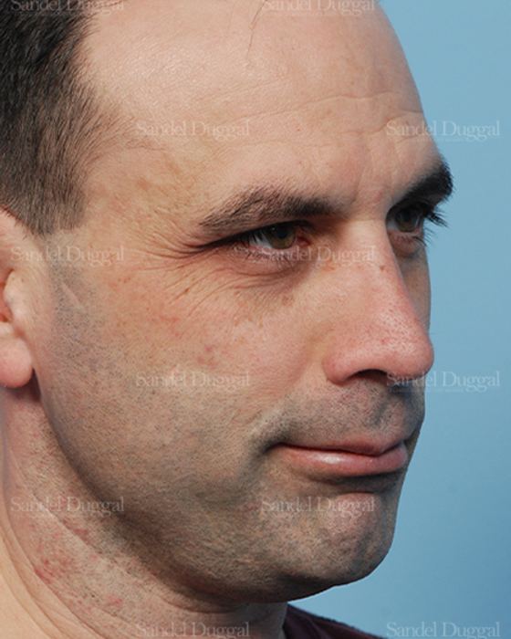 Rhinoplasty after, case 2909