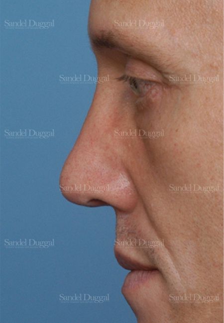 Revision Rhinoplasty after, case 2609