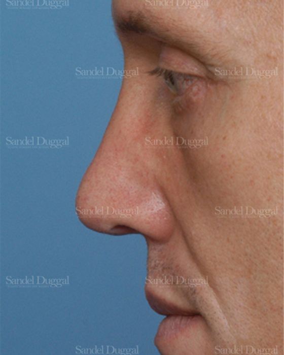 Revision Rhinoplasty after, case 2609