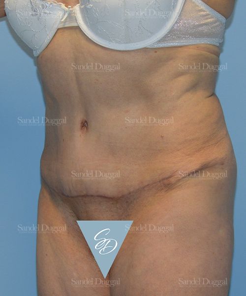 Tummy Tuck after, case 1729