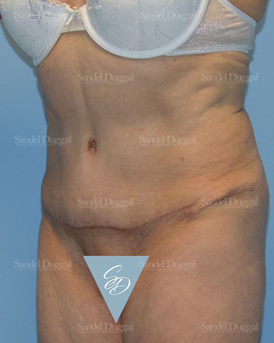 Tummy Tuck after, case 1729
