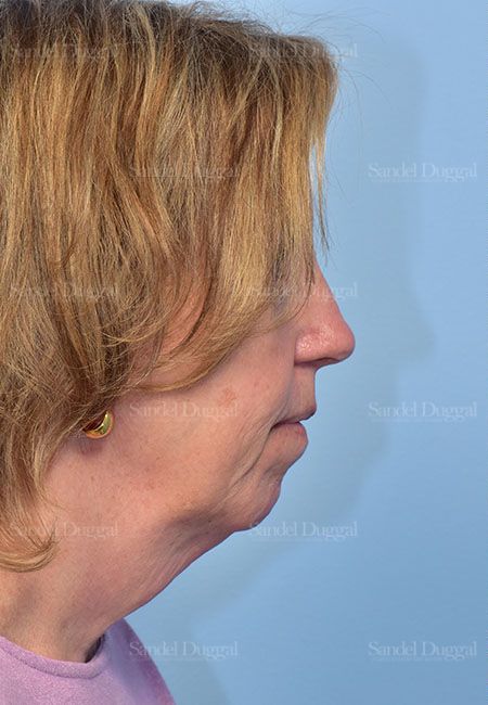 Facelift before, case 5686