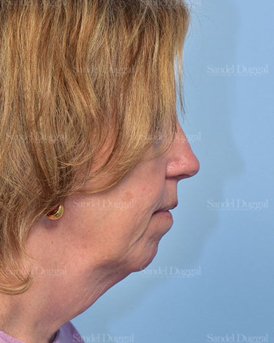 Facelift before, case 5686