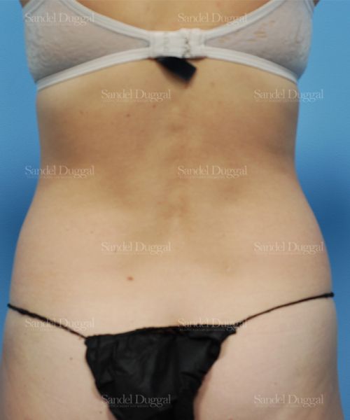 Liposuction — Legs & Flanks before, case 2526