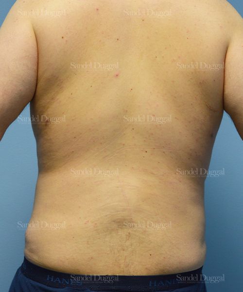 Liposuction — Legs & Flanks after, case 2545
