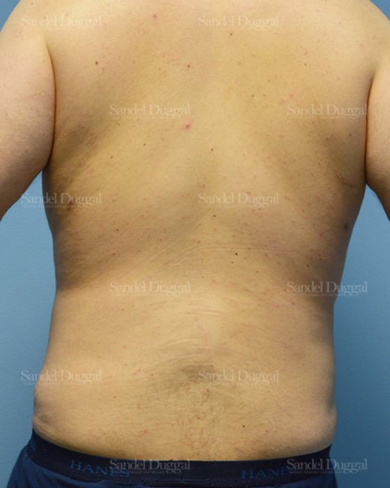 Liposuction — Legs & Flanks after, case 2545
