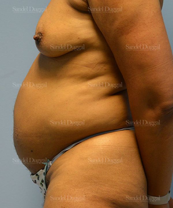Tummy Tuck before, case 1510